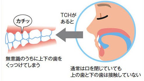 膜 炎 歯根 [歯痛]急に噛むと痛くなる歯根膜炎,皆の症状