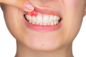 痛い と 歯茎 押す を 歯茎の上の方が押さえると痛みます。