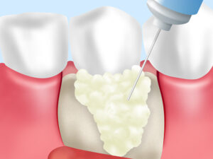 甲府市の歯医者、降矢歯科クリニック歯科・矯正の歯周組織再生療法
