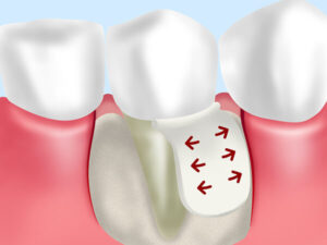 甲府市の歯医者、降矢歯科クリニック歯科・矯正の歯周組織再生療法