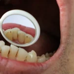 甲府市の歯医者なら、降矢歯科クリニック 歯科・矯正で前歯の裏側に歯石がつきやすい理由と落とす方法を解説