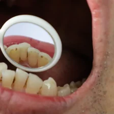 甲府市の歯医者なら、降矢歯科クリニック 歯科・矯正で前歯の裏側に歯石がつきやすい理由と落とす方法を解説