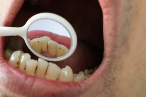 甲府市の歯医者、降矢歯科クリニック 歯科・矯正で前歯の裏側に歯石がつきやすい理由と落とす方法を解説