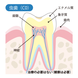 甲府市の歯医者なら、降矢歯科クリニック 歯科・矯正で初期虫歯の再石灰化が起こりにくい人にはどんな特徴がある？生活習慣や口内環境を解説